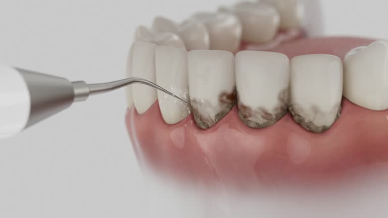 Trusted Tooth Extraction service in Cleveland, OH - Dentist Open Now